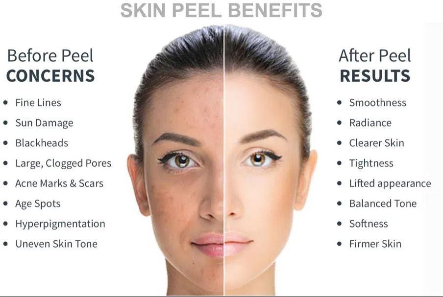 What to Expect: Downtime and Peeling After a Chemical Peel