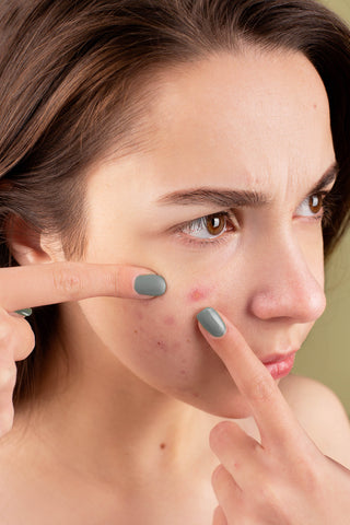 Clearer Skin Starts Here: Why Facials and Quality Skincare Are Key for Acne