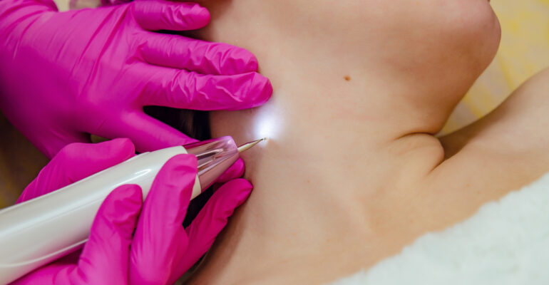 Say Goodbye to Skin Imperfections: Wart, Skin Tag, and Milia Removal