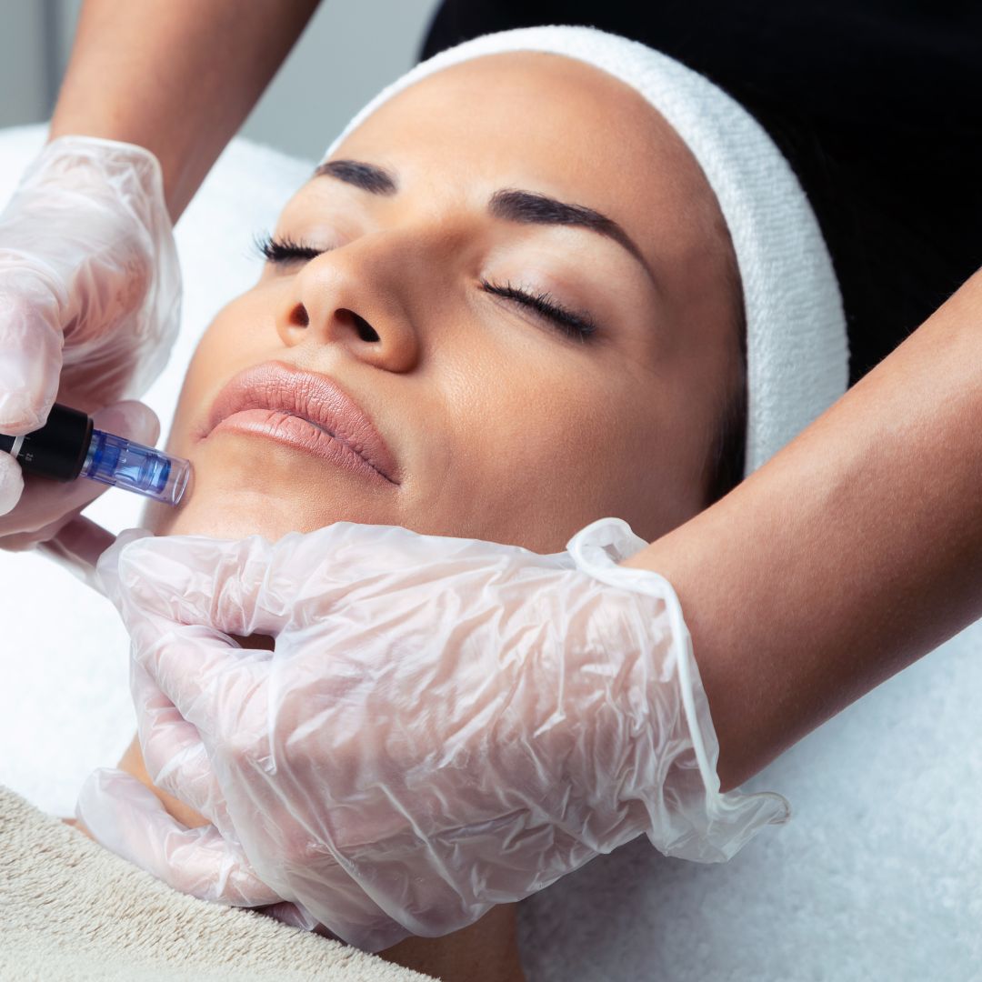 What is Microneedling and why should you have it?