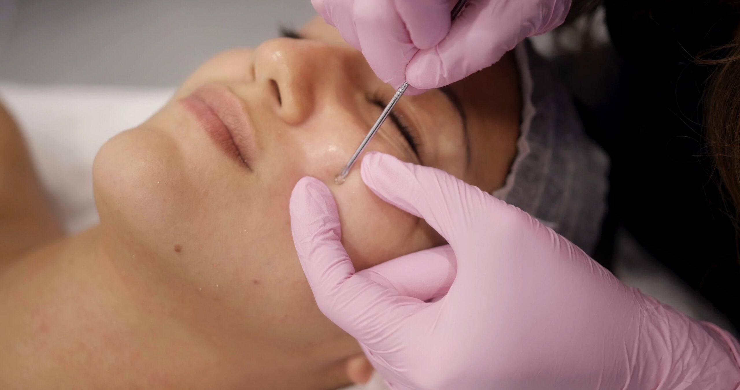 The Power of Extraction: How It Transforms Your Skin.